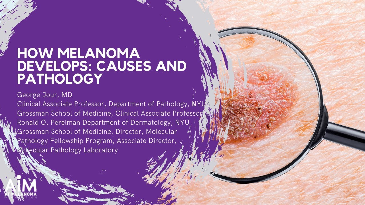 How Melanoma Develops: Causes and Pathology