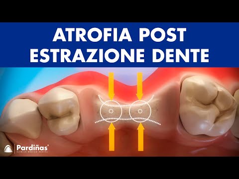 Atrofia post-estrazione dente ©