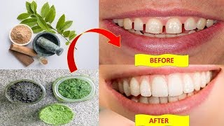 How to fix gap between teeth naturally at home without braces - Health Pavilion BRIGHT SIDE