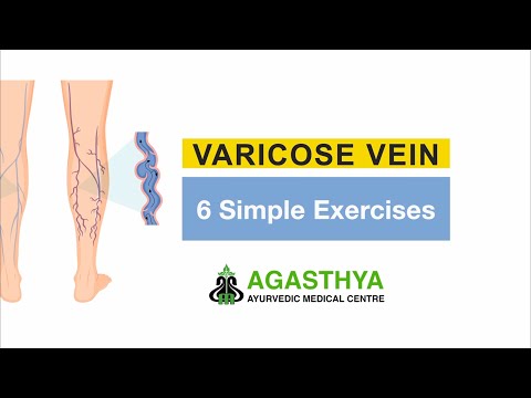 6 Simple Exercises for Varicose Veins — Agasthya Ayurvedic Hospital