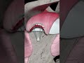 Rotator Cuff Repair Animation