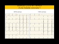 Infarctus ou et HVG ? Quiz.  Dr Taboulet