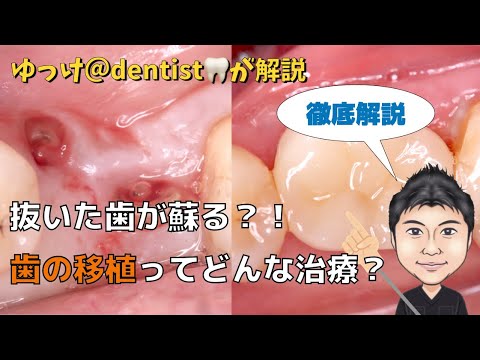 生命歯学科 「歯の移植」を徹底解説！歯を抜くのちょっと待った！親知らずがあればあなたの歯を救う