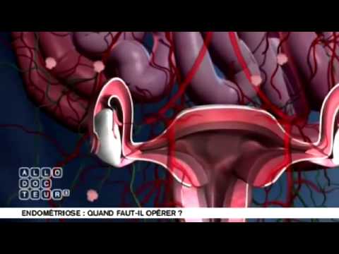 comment poser un ovule