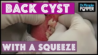 An initially nervous patient with a popaholic wife: Nice Cyst Squeeze &amp; whiteheads!