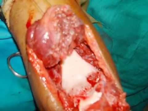 comment soigner varicocele