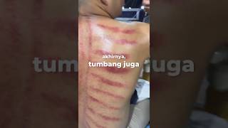 Download lagu Akhirnya tumbang juga • Kerokan kunci tolak masuk angin, akumulasi berpetualang bareng #RSTKA mp3 Download lagu Akhirnya tumbang juga • Kerokan kunci tolak masuk angin, akumulasi berpetualang bareng #RSTKA mp3