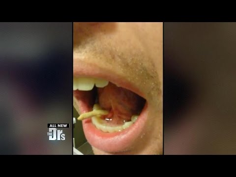 Sintomas del papiloma humano en boca