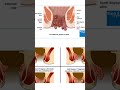 Degrees Of Piles Surgery Dr Piles