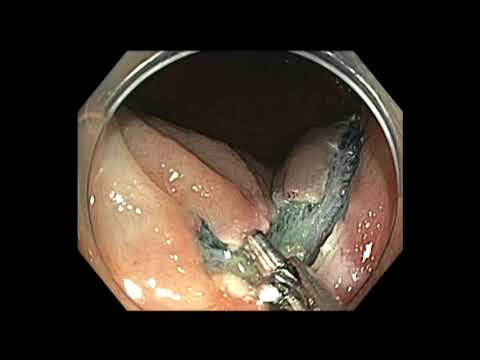 Colonoscopy: Cecal Polyp Hidden by a Fold