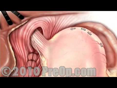 Hernia Hiatal Laparoscopic PreOp® Patient Education Feature