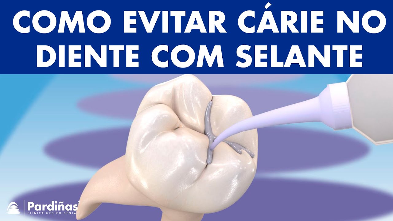 Como EVITAR CÁRIE no diente com selante dentário ©