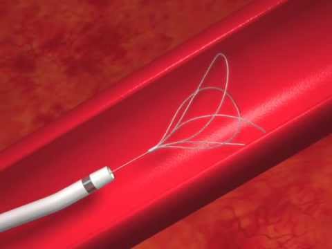 Polypectomy Snares