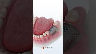 Download lagu Bone Tack and Tenting Screw Kit! 🦷 #Dentistry #gbr mp3 Download lagu Bone Tack and Tenting Screw Kit! 🦷 #Dentistry #gbr mp3