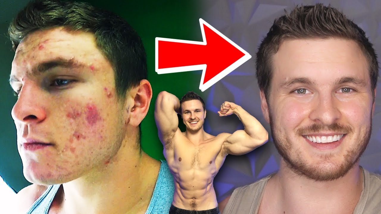 Putar video Apakah Bulking Menyebabkan Jerawat sekarang Apakah Bulking Menyebabkan Jerawat
