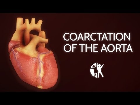 Coarctation of the Aorta - YouTube