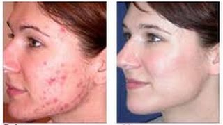 how to remove redness of acne - how to get rid of pimples fast