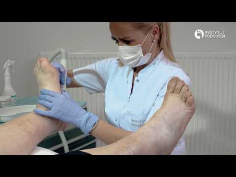 Koślawego masaż stóp wideo Jak zapobiec deformacji palucha