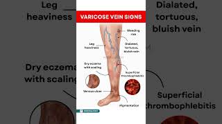 Stop Ignoring These Leg Warning Signs #varicoseveins #shorts