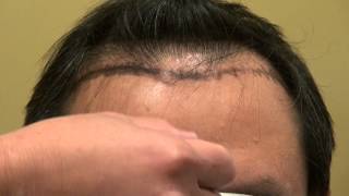 preview picture of video 'FUE Hair Loss Restoration Surgery Dr. Diep www.mhtaclinic.com Los Gatos Near San Jose CA'