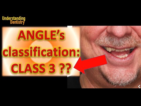 Easy: Angle’s Classification of Malocclusion. Quick Tutorial of Orthodontics
