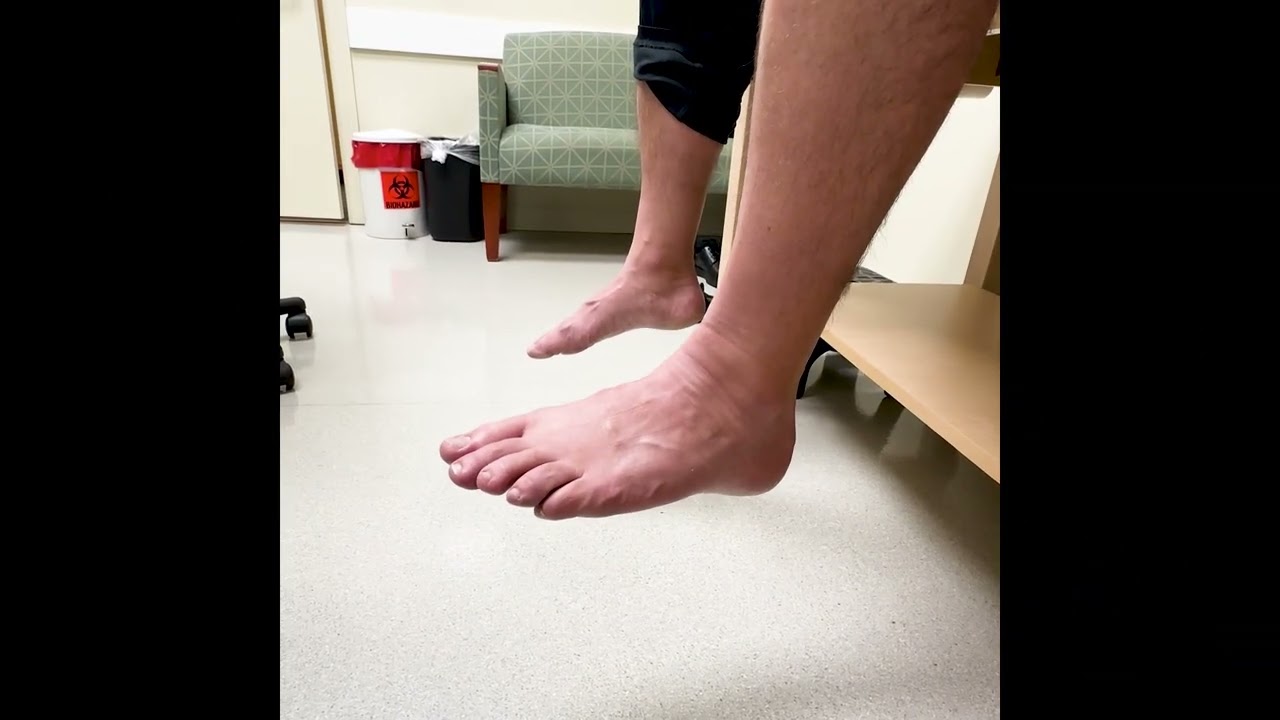 Foot Drop Recovery Three Months Post Op