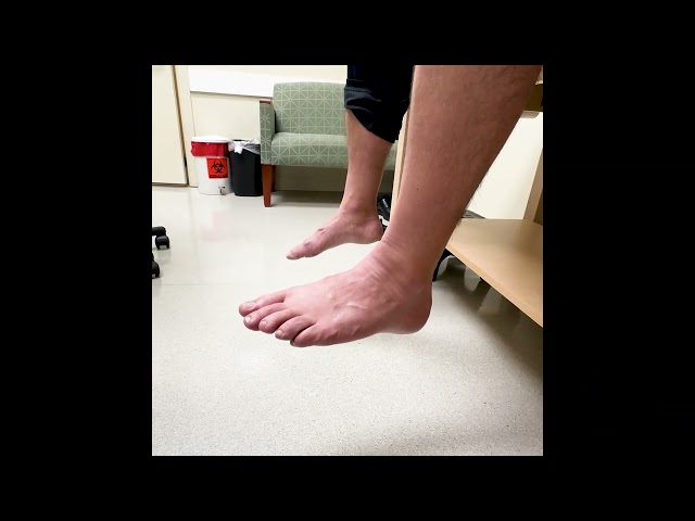 Foot Drop Recovery Three Months Post Op