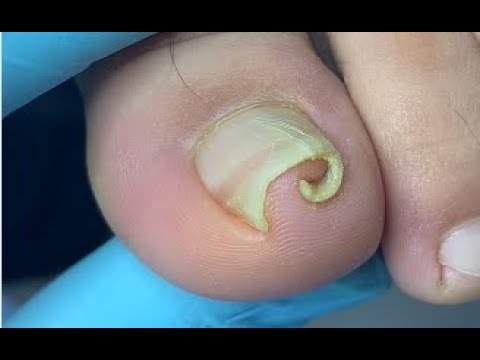 How to repair curled nail