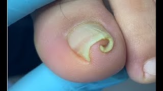 How to repair curled nail