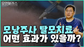탈모치료 모낭주사로 극복가능?