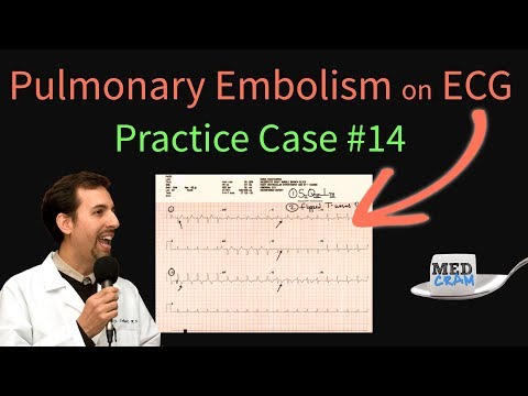 ECG Findings in Pulmonary Embolism - EKG Changes With an Acute PE