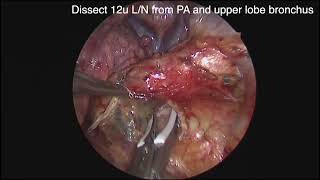 Asvide: A young surgeon performing a right upper lobectomy.