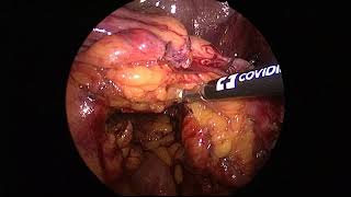 Download Lagu Laparosopic Sigmoid Resection Rectopexy for Rectal Prolapse (intracorporeal anvil placement) Thumbnail