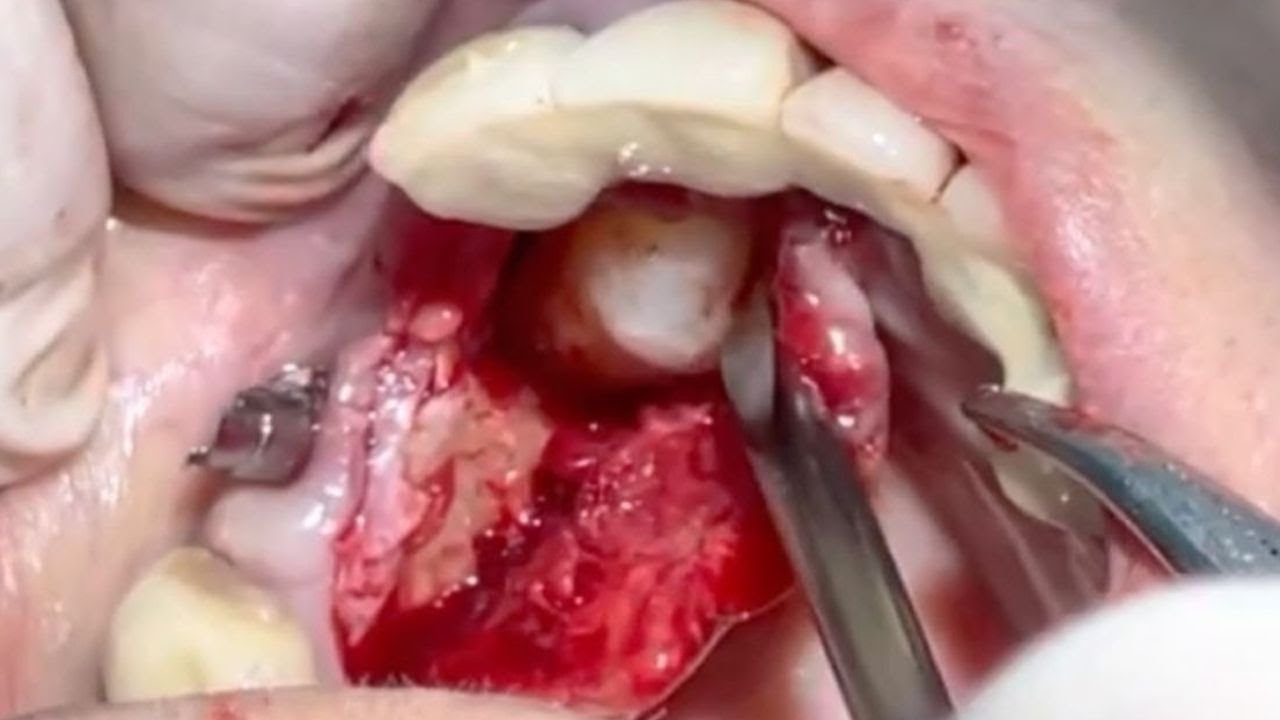 Canino incluso nel palato estrazione dentale