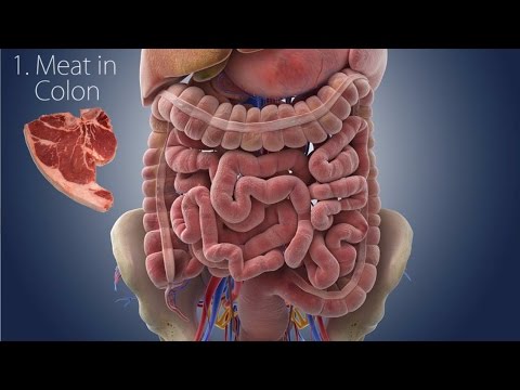 Cause and Cure?: Ulcerative Colitis