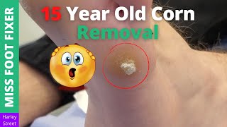 15 Year Old Corn Removal | Miss Foot Fixer | Marion Yau