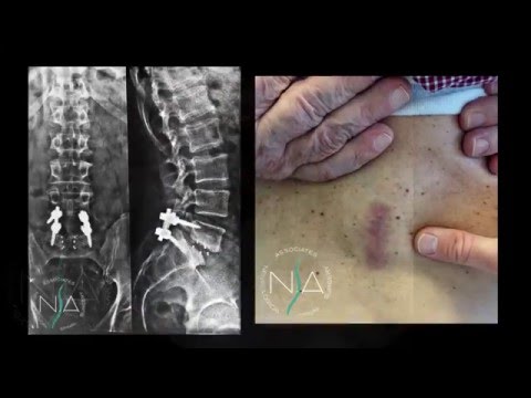Mal di schiena rotavirus Quale procedura per scegliere il trattamento della colonna vertebrale in un sanatorio