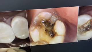 Mercury Filling Removal: Safety & Fillings Instead Of Crowns