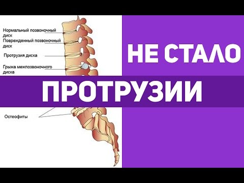 У меня иногда болит поясница Головной боль и остеохондроз