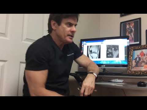 Avascular Necrosis and Stem Cells - Dr. Lox