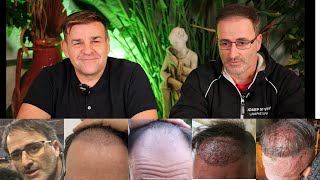 TRASPLANTE CAPILAR SIN RAPAR BARCELONA 4 MESES EVOLUCIÓN