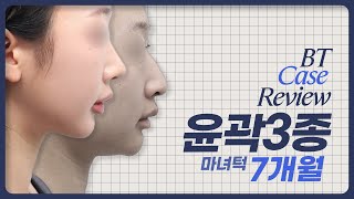 마녀턱 케이스 리뷰ㅣ비티성형외과