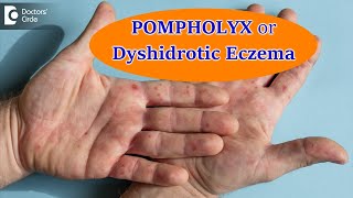 DYSHIDROTIC ECZEMA OR POMPHOLYX: Causes,Symptoms, & Treatment - Dr. Aruna Prasad | Doctors