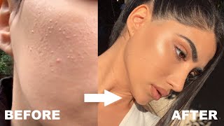 HOW I GOT RID OF STUBBORN BUMPS AND TEXTURED SKIN