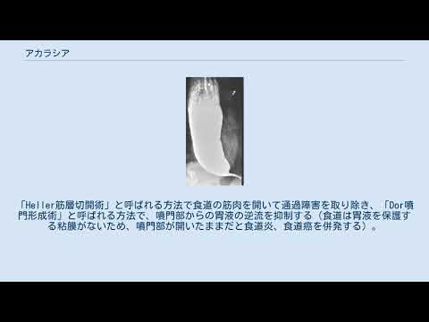 アカラシアについて詳しく解説