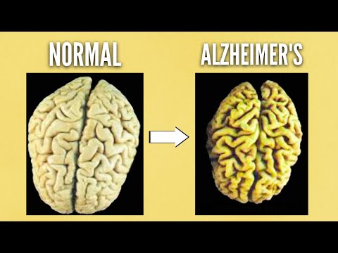 The BIGGEST  reason people get Alzheimer's Disease (DEMENTIA)