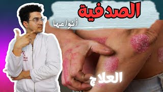 هل الصدفية مرض معدي ؟ | أنواع الصدفية | علاج الصدفية وكيفية التعامل معها - Psoriasis