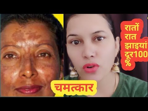 कितनी पुरानी झाइयां pigmentation जड़ से खत्म करने का घरेलू नुस्खे 100% result/how to remove malasm
