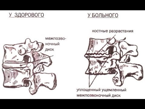 Мазь от сустава и мышцы название Пункция сустава как делается