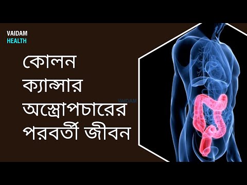 কোলন ক্যান্সার অস্ত্রোপচারের পরবর্তী জীবন